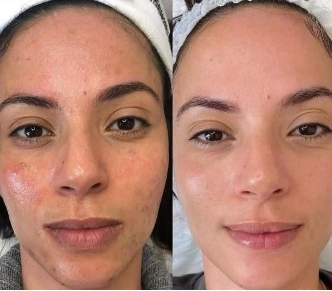 Antes e depois — Laser CO2 Fracionado: manchas e textura da pele