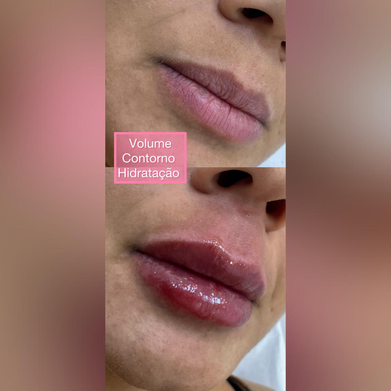 Antes e depois — Preenchimento labial: volume, contorno e hidratação