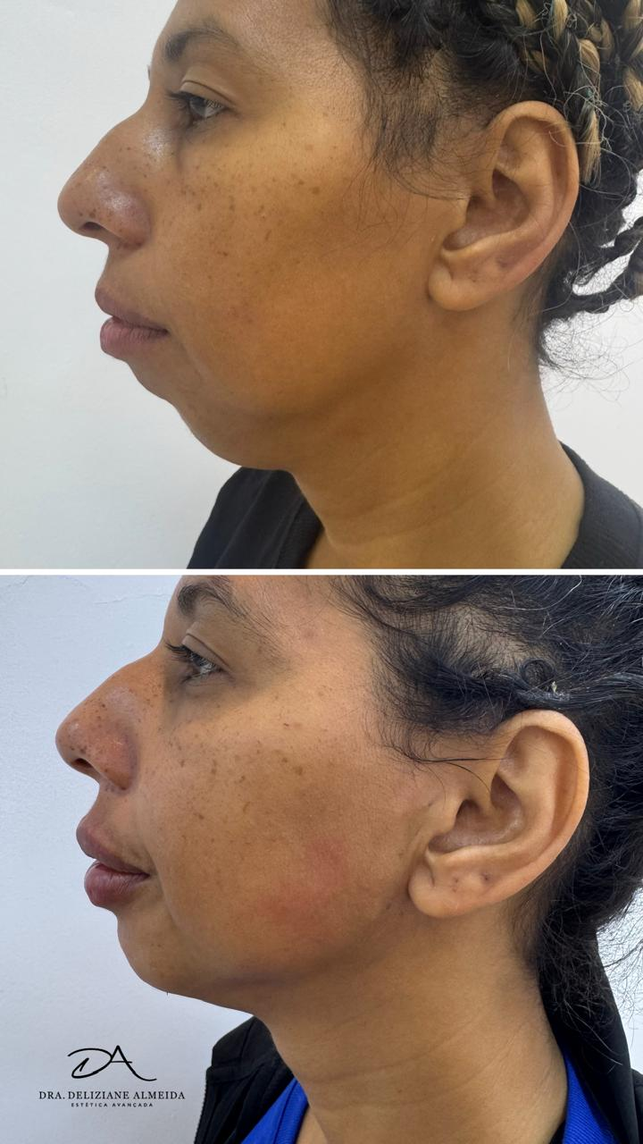 Antes e depois — Fios de PDO: Lifting Facial sem cortes