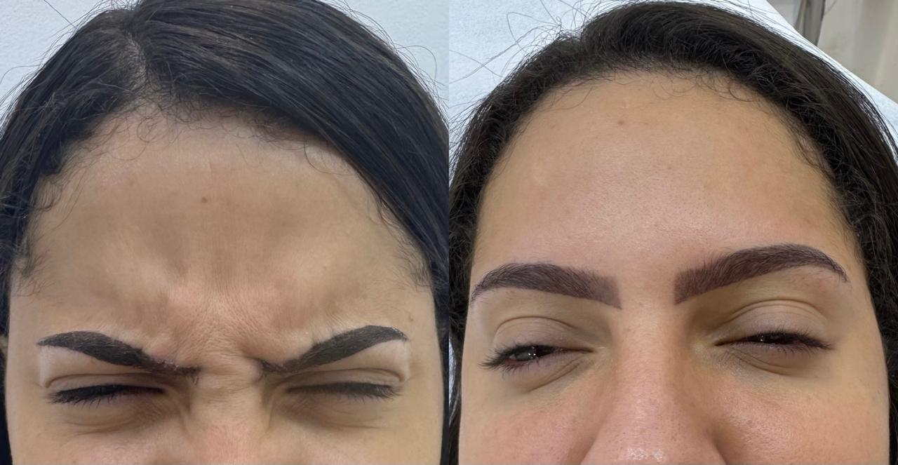 Antes e depois — Botox na glabela (linhas entre as sobrancelhas)
