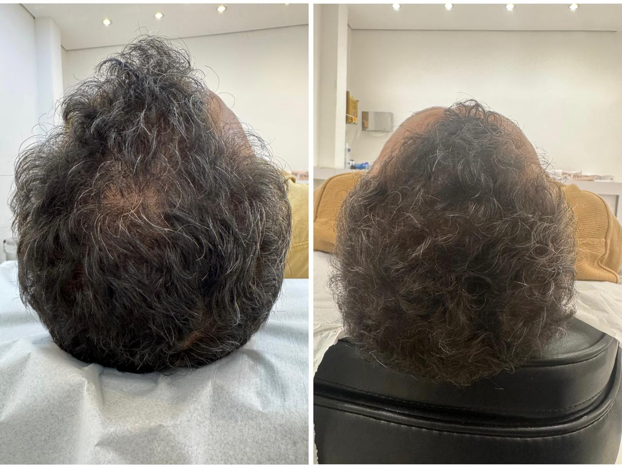 Antes e depois — Intradermoterapia capilar: densidade e crescimento dos fios